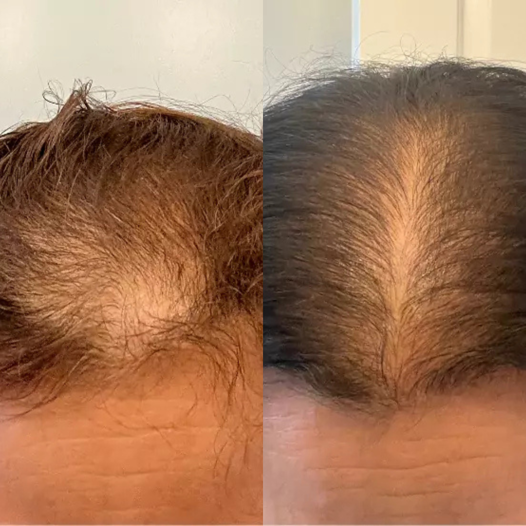 ReNuStrand™ Hair Growth Gummies