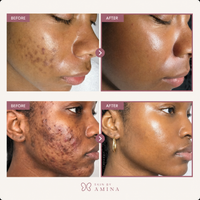 NABI - Alpha Arbutin + TXA Cream